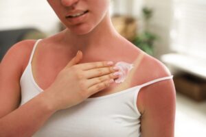 Deze veelvoorkomende reactie na zonnebrand verergert de huidschade